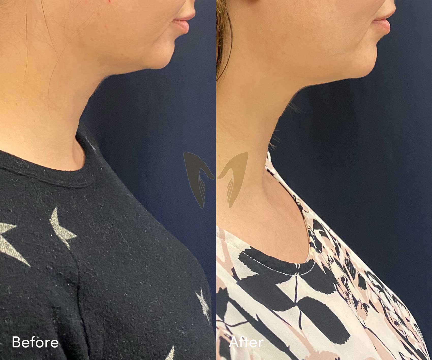 - One Double Chin Reduction