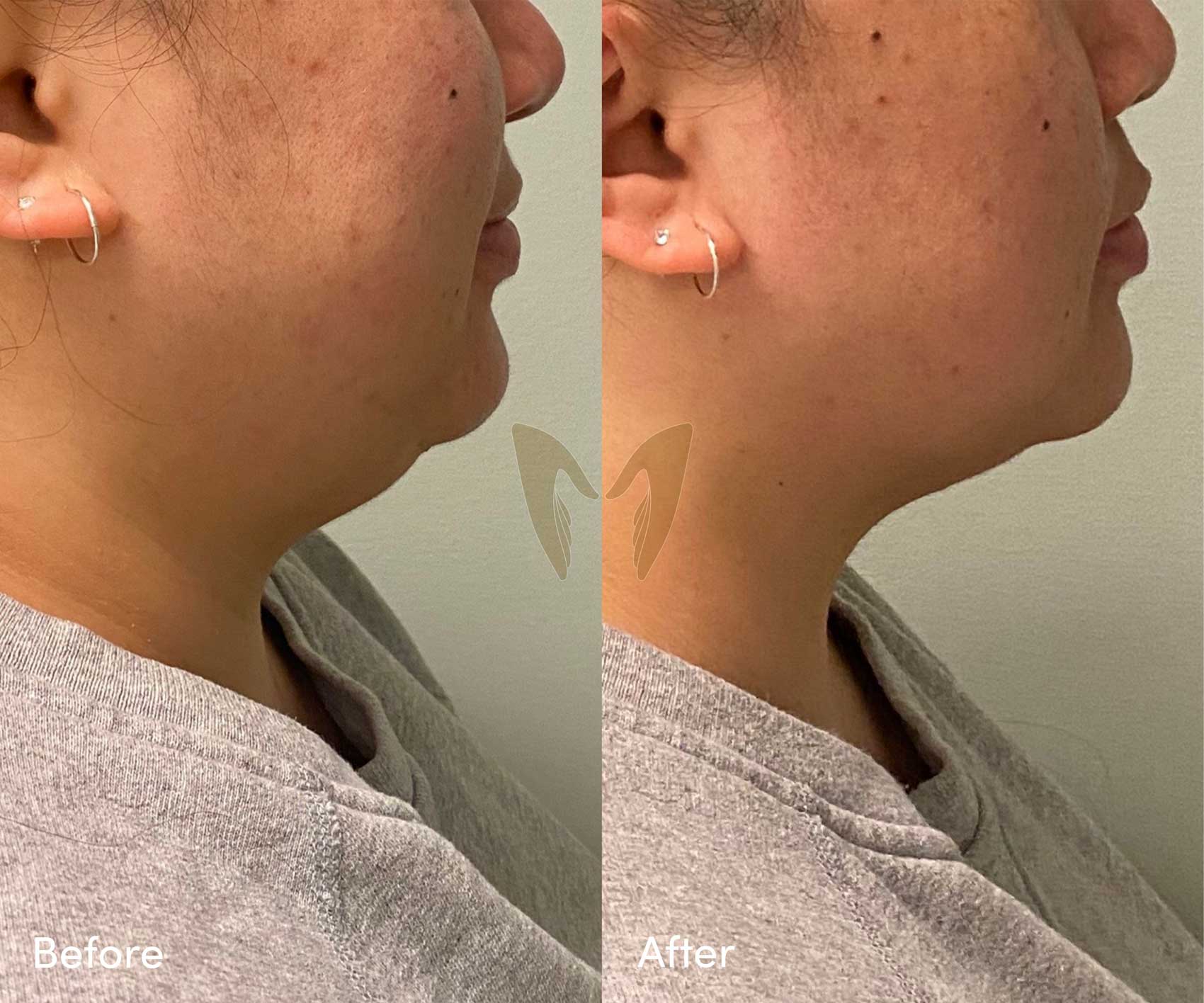 - Two Double Chin Reduction