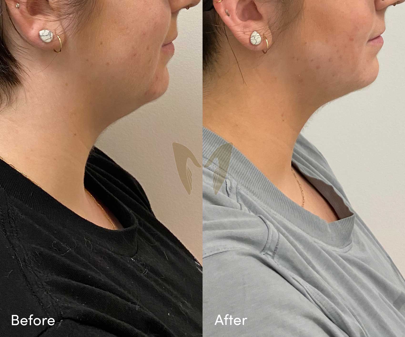 - One Double Chin Reduction